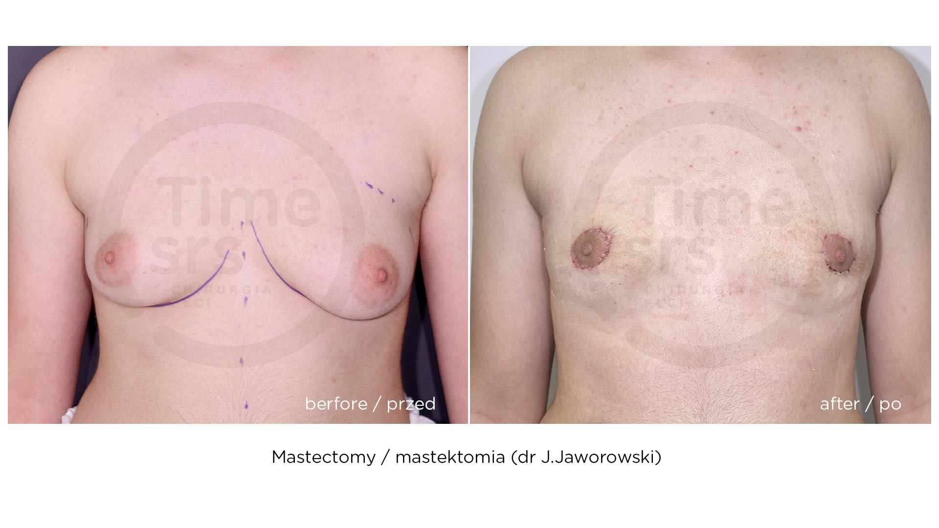 SRS-mastektomia-przed-po-chirurgiaplci-1