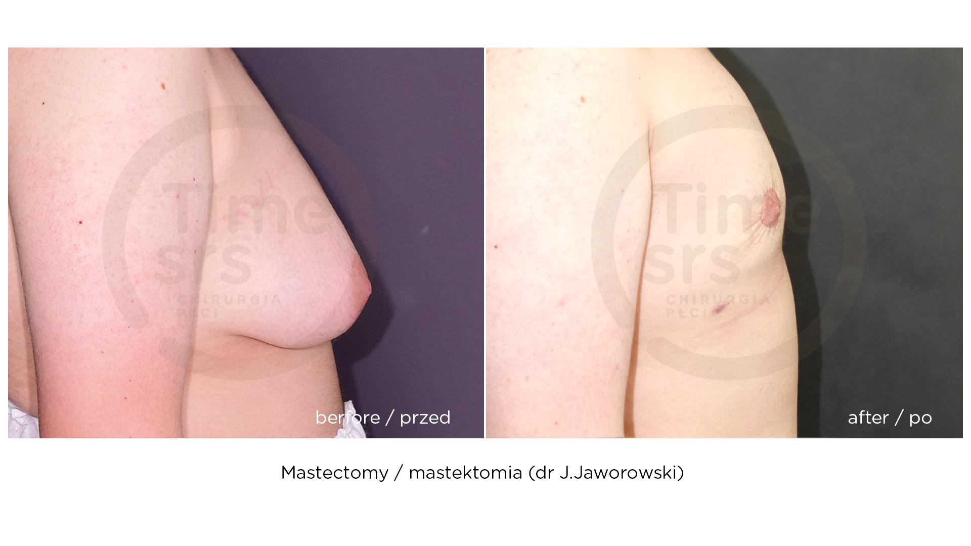 SRS-mastektomia-przed-po-chirurgiaplci-5