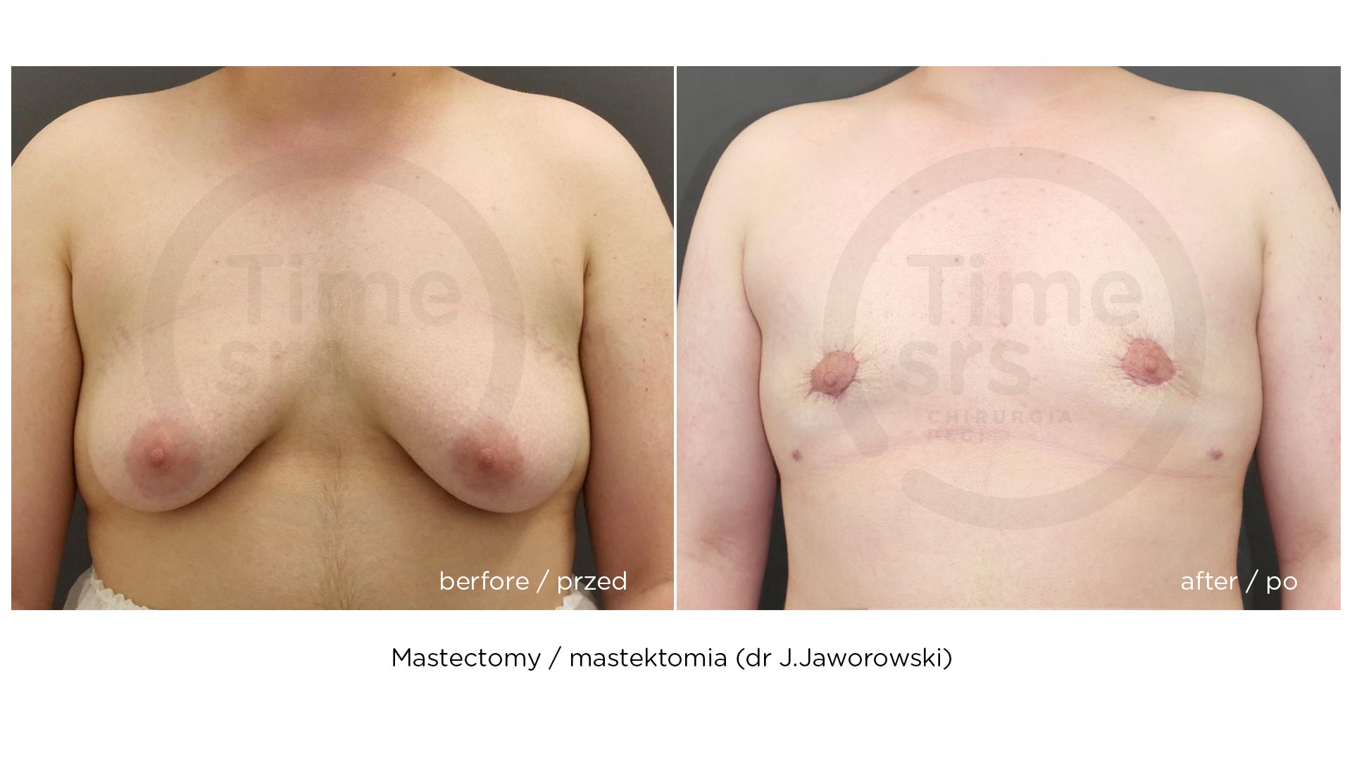 SRS-mastektomia-przed-po-chirurgiaplci-6