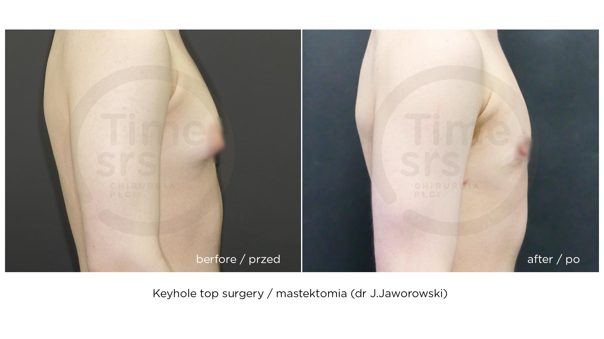 top surgery - mastektomia keyhole - przed i efekt po operacji
