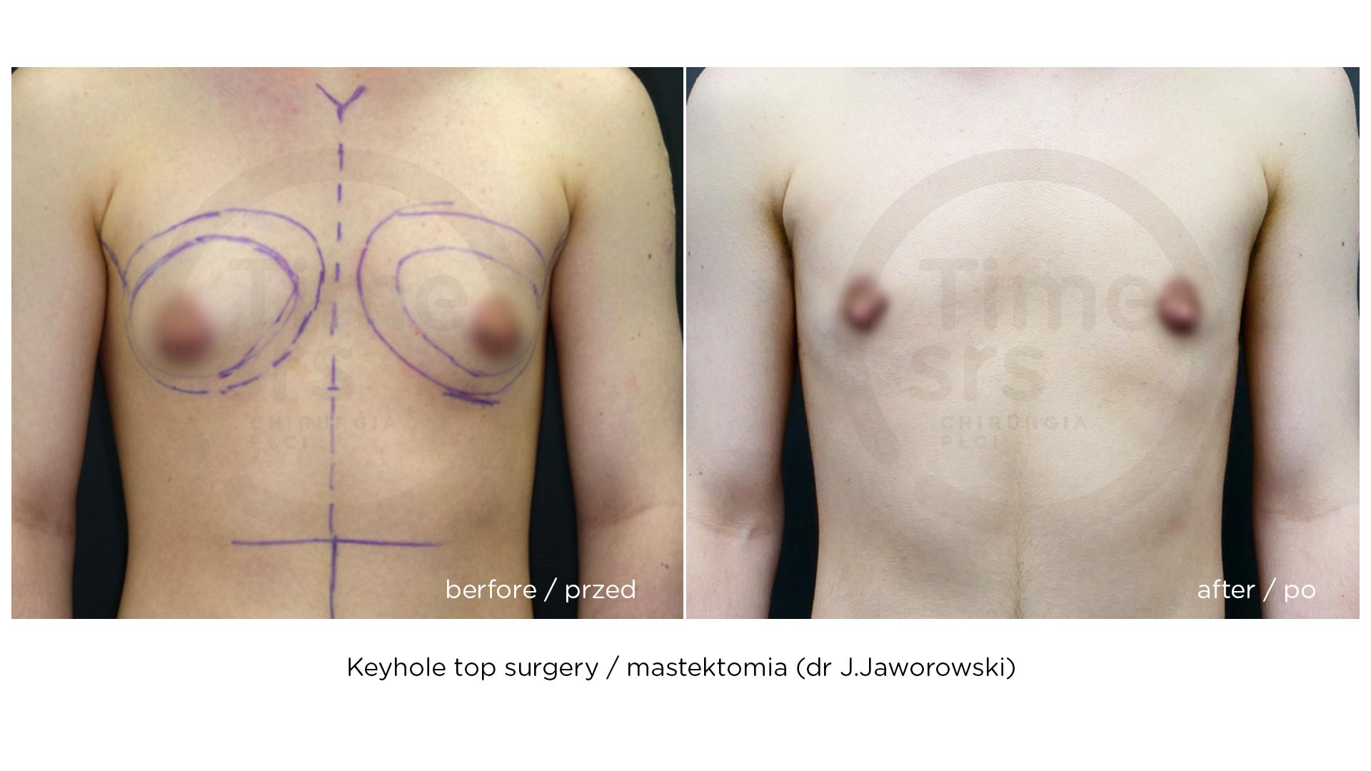 keyhole-top-surgery-2020b