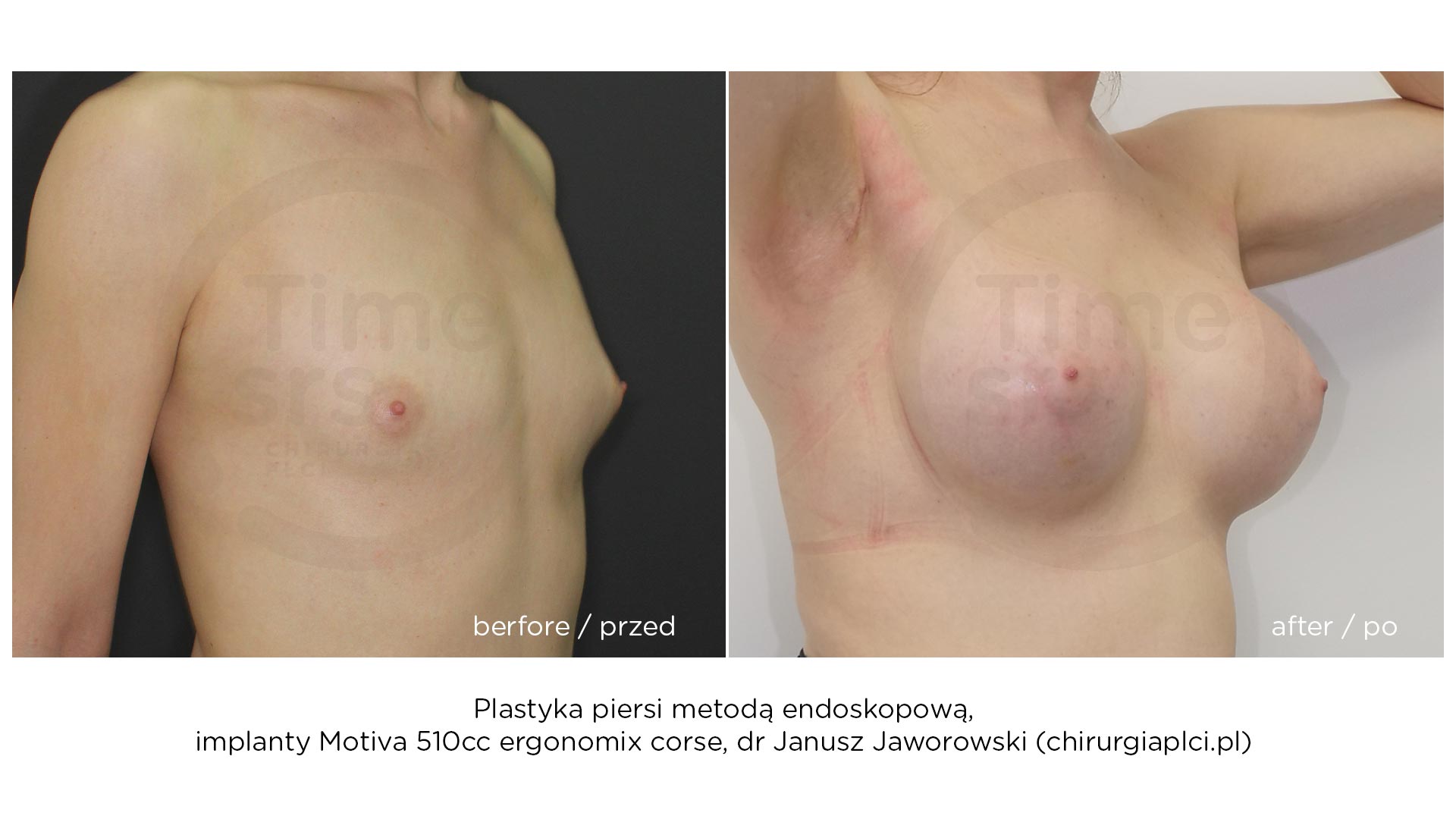 KM-implanty-piersi-przed-po-2021-2