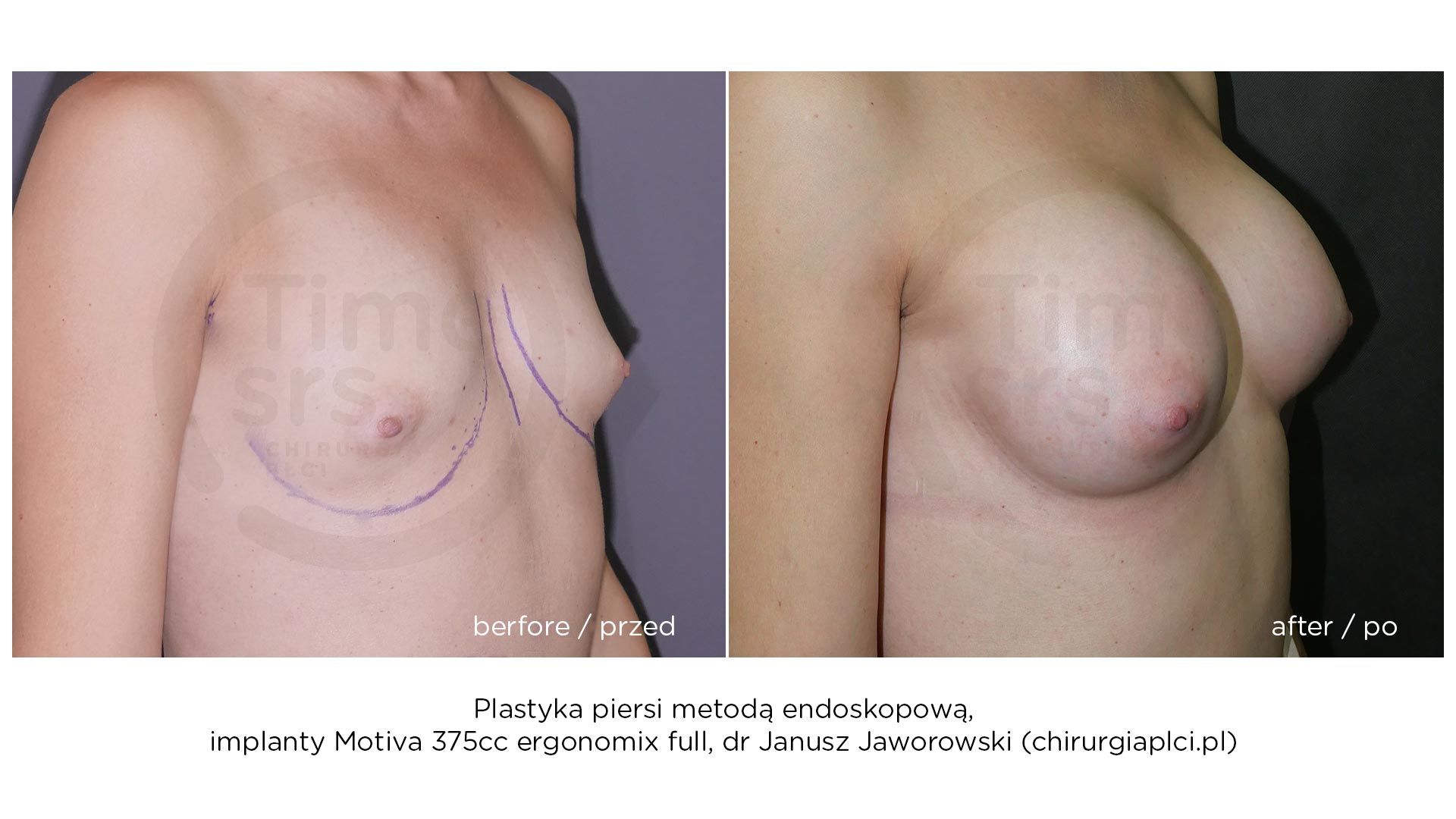 KM-implanty-piersi-przed-po-2021-3
