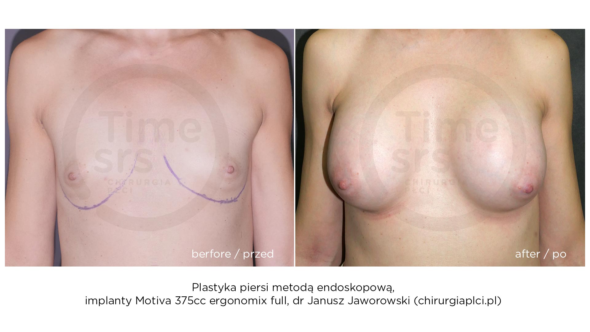 KM-implanty-piersi-przed-po-2021-5
