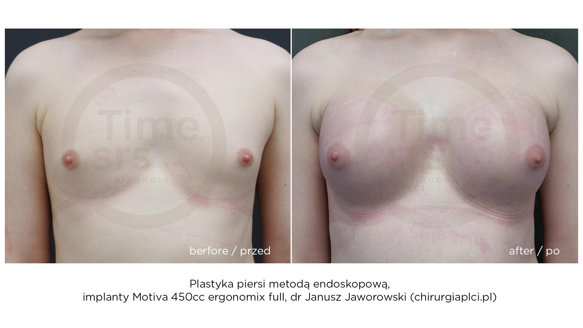 KM-implanty-piersi-przed-po-2021-6