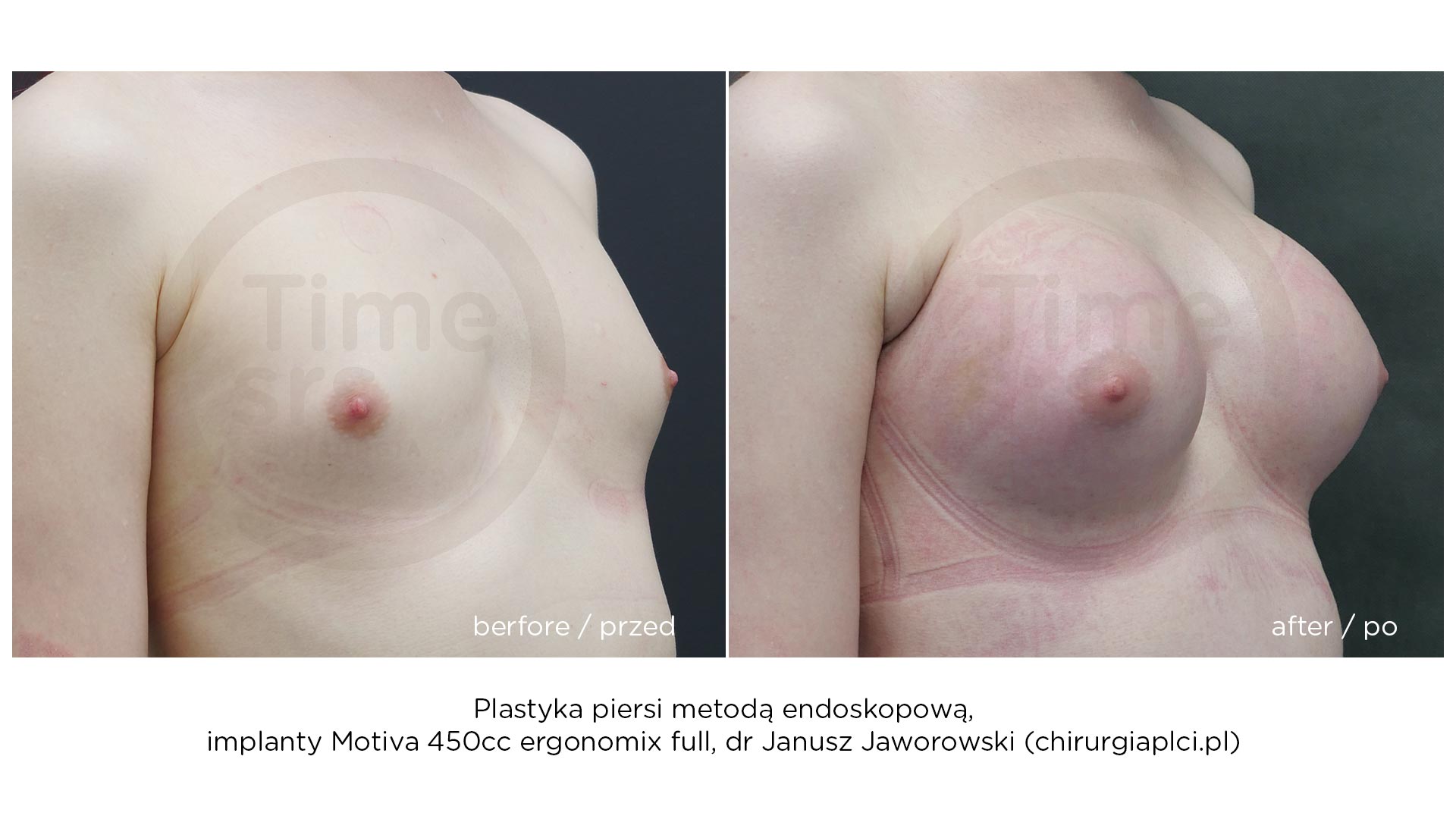 KM-implanty-piersi-przed-po-2021-7