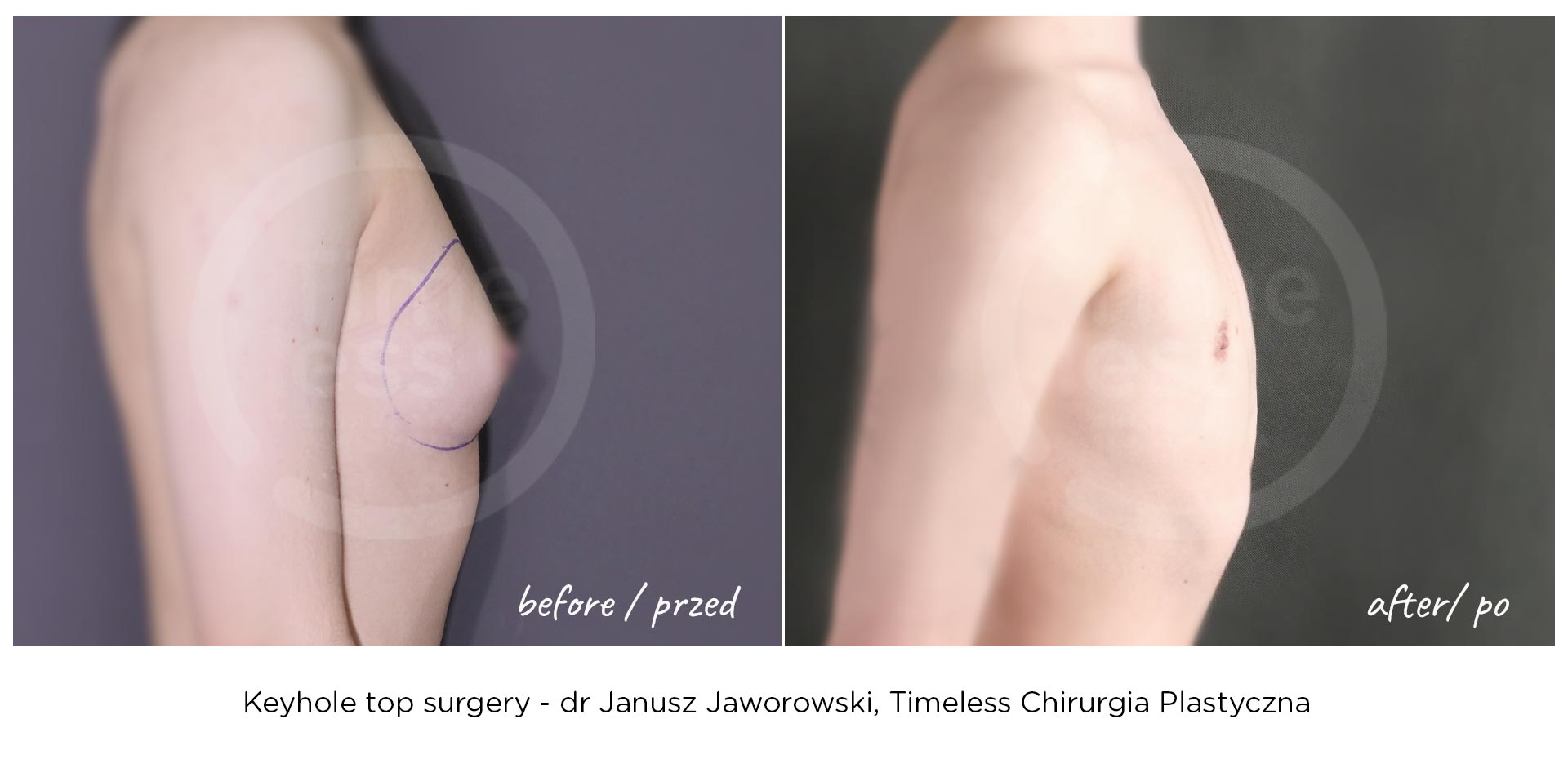 SRS-www-chirurgiaplci-przed-po-topsurgery-5