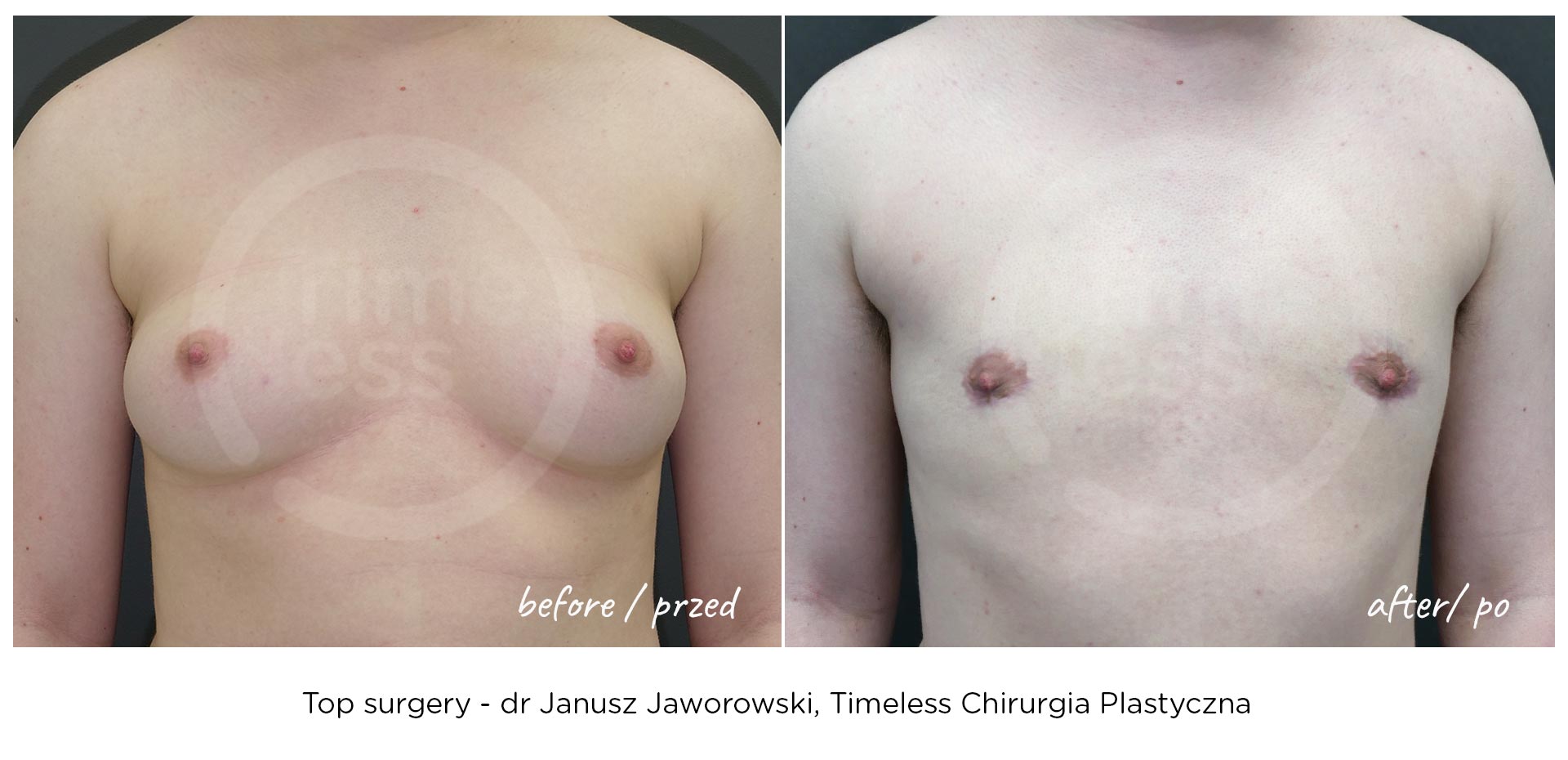 top surgery - mastektomia - przed i po operacji