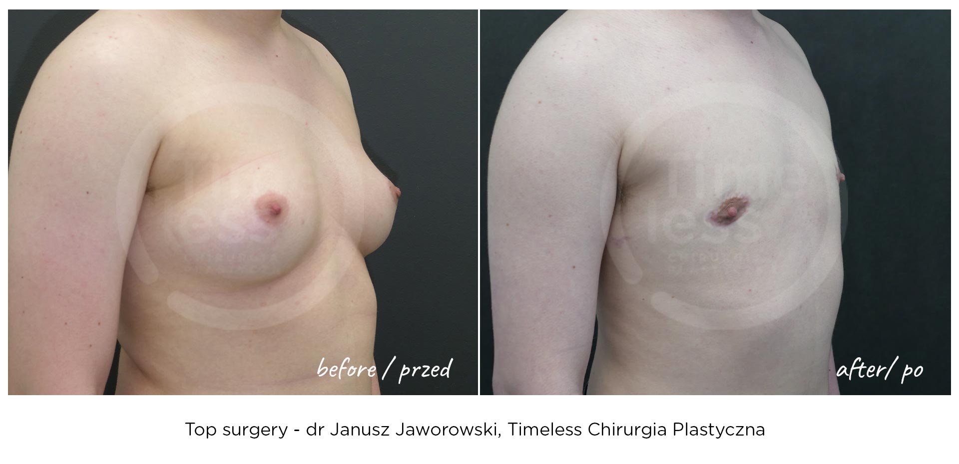 top surgery - mastektomia - przed i po operacji