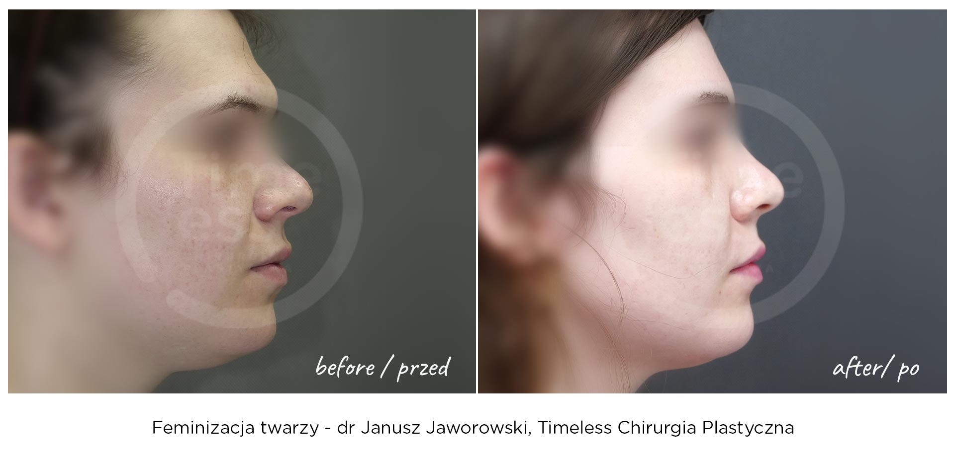 feminizacja-twarzy-chirurgiaplci-przed-po