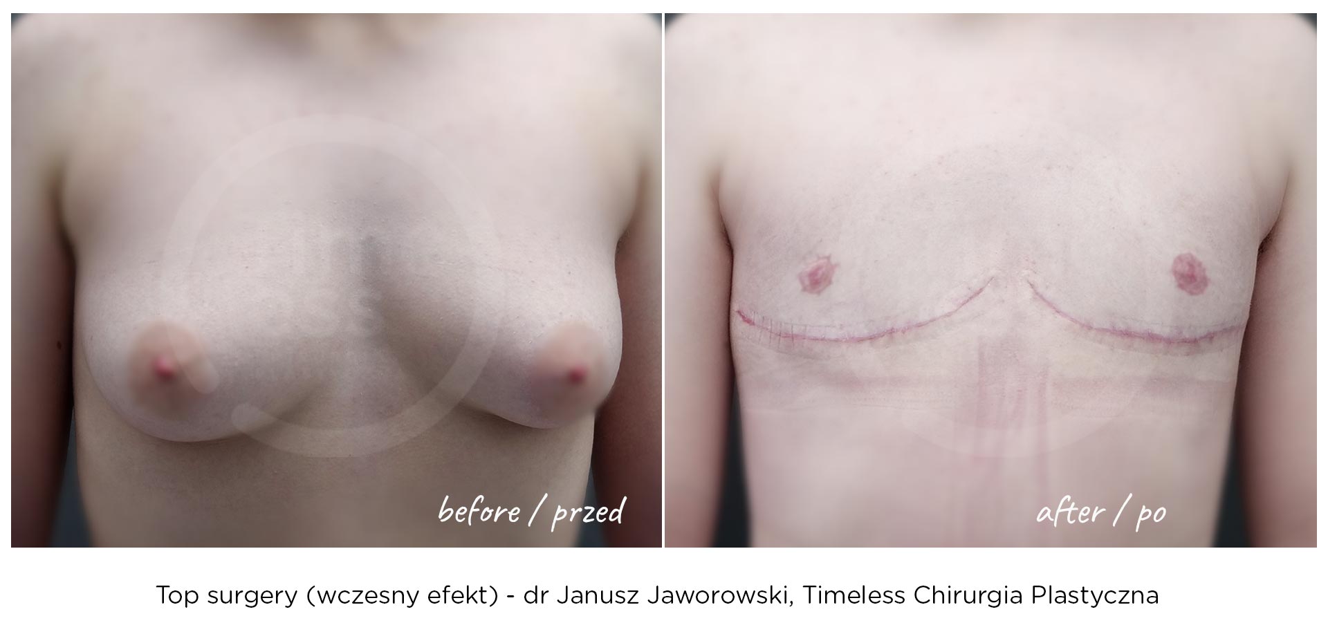 top-surgery-wczesny-efekt-chirurgiaplci-2024a